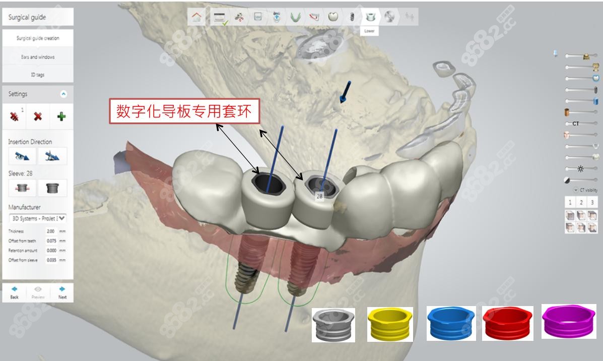 愛迪特：3D打印牙冠技術(shù)在理論上是可行的且具有廣闊的臨床應(yīng)用前景